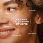 Murad Biome-Balancing Acne Treatment – Salicylic, Mandelic, and Glutamic Acid Serum for Clearing and Preventing Breakouts, Decongesting Pores, and Balancing Skin Microbiome – 1.0 Fl Oz - Image 3