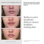 Murad Biome-Balancing Acne Treatment – Salicylic, Mandelic, and Glutamic Acid Serum for Clearing and Preventing Breakouts, Decongesting Pores, and Balancing Skin Microbiome – 1.0 Fl Oz - Image 5